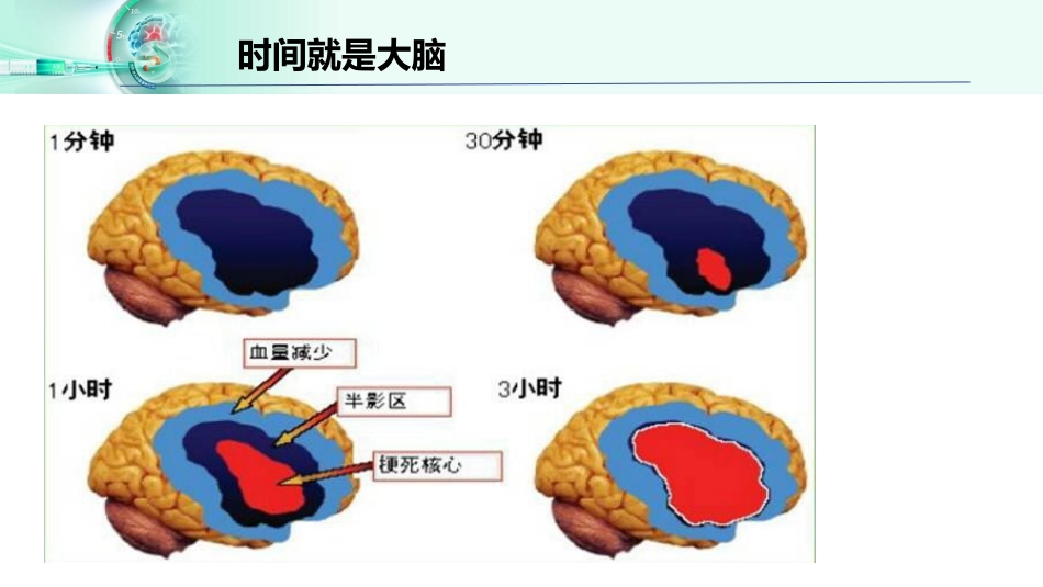 脑梗死静脉溶栓_第7页