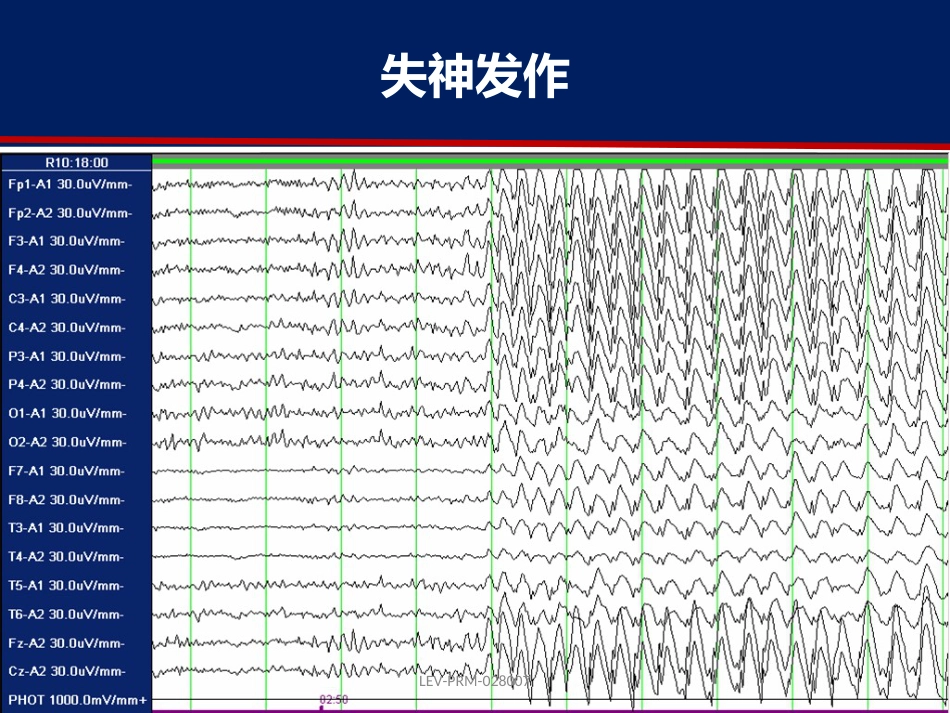 癫痫的诊断和鉴别诊断_第15页
