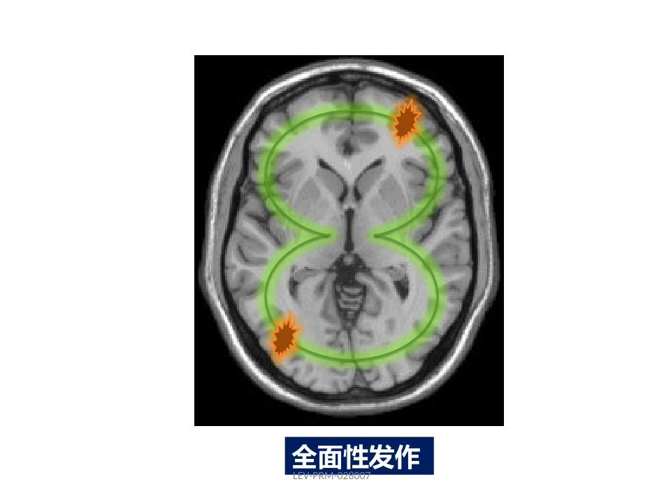 癫痫的诊断和鉴别诊断_第8页