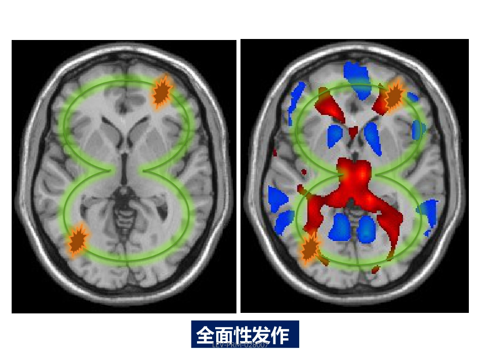 癫痫的诊断和鉴别诊断_第9页