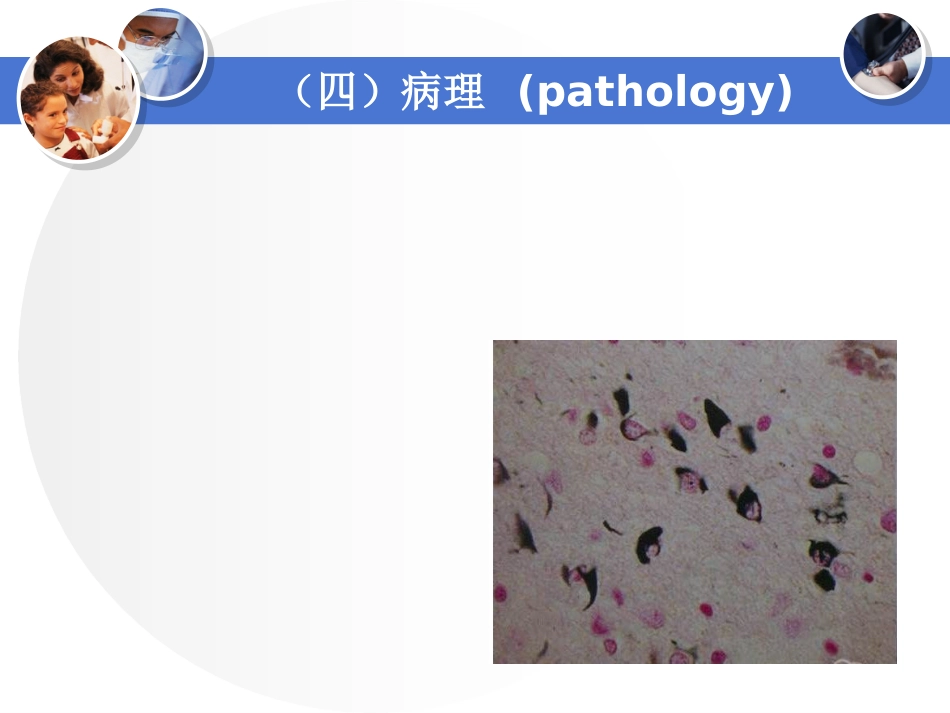 多系统萎缩_第5页