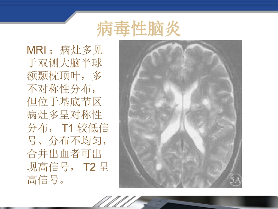 Fahr's病及鉴别_第11页
