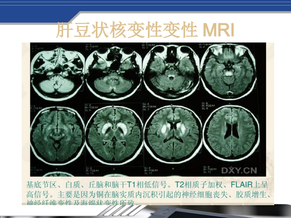 Fahr's病及鉴别_第13页