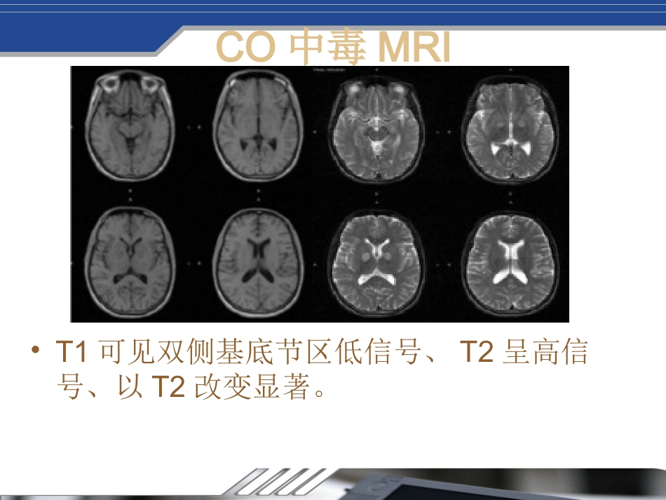 Fahr's病及鉴别_第7页