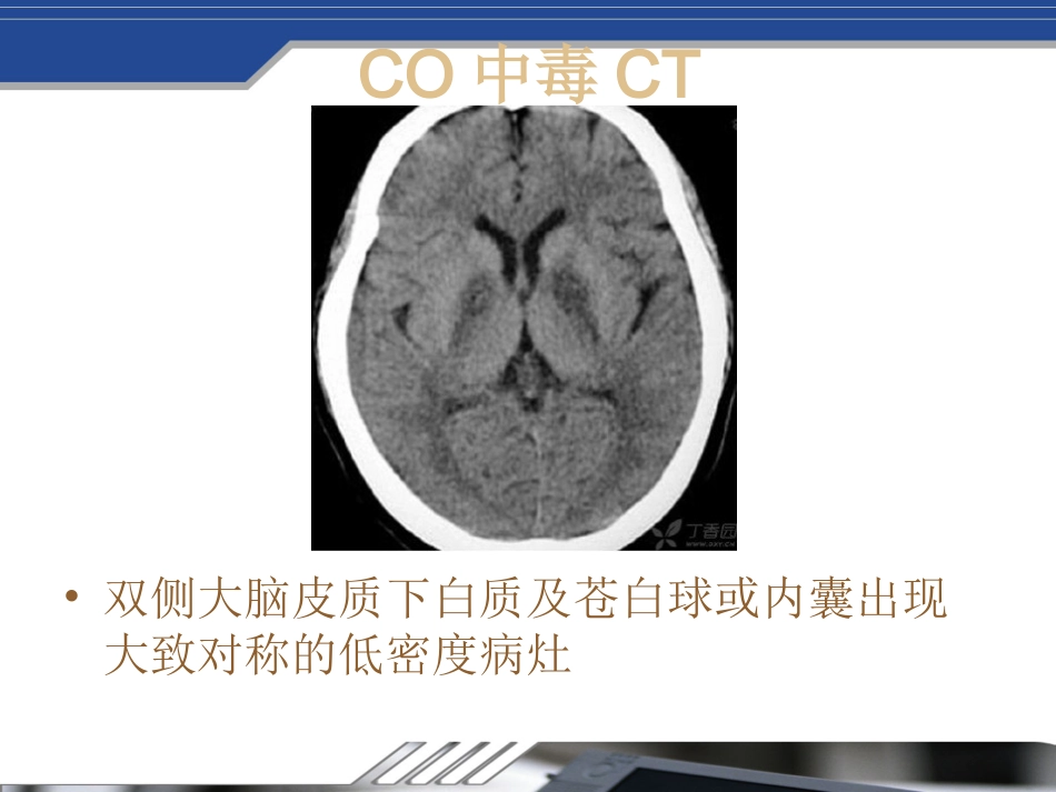 Fahr's病及鉴别_第8页