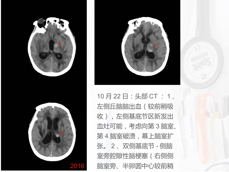 病例汇报：一位53岁反复卒中的女性患者_第10页