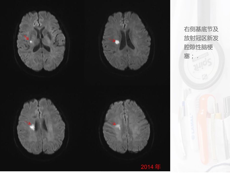 病例汇报：一位53岁反复卒中的女性患者_第5页