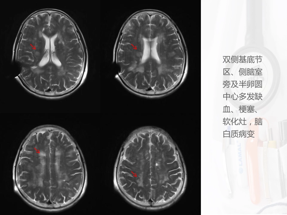 病例汇报：一位53岁反复卒中的女性患者_第6页