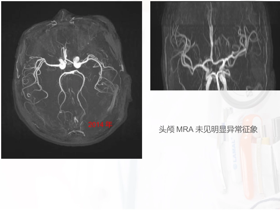 病例汇报：一位53岁反复卒中的女性患者_第8页