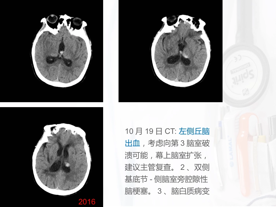 病例汇报：一位53岁反复卒中的女性患者_第9页