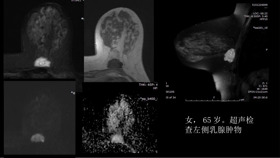 乳腺粘液腺癌MR与病理特点_第11页