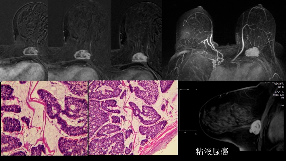 乳腺粘液腺癌MR与病理特点_第12页