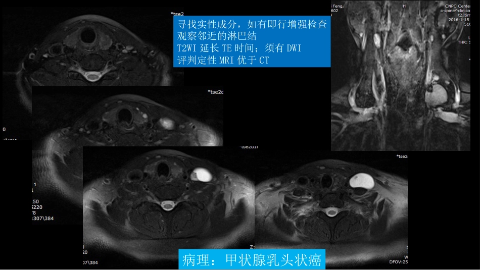 乳腺粘液腺癌MR与病理特点_第15页