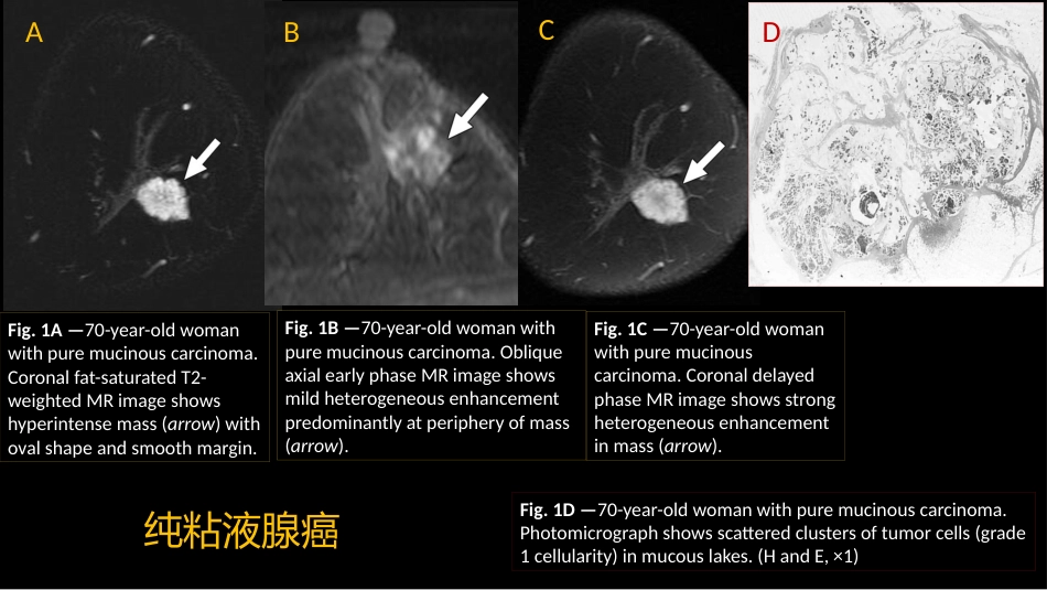 乳腺粘液腺癌MR与病理特点_第2页