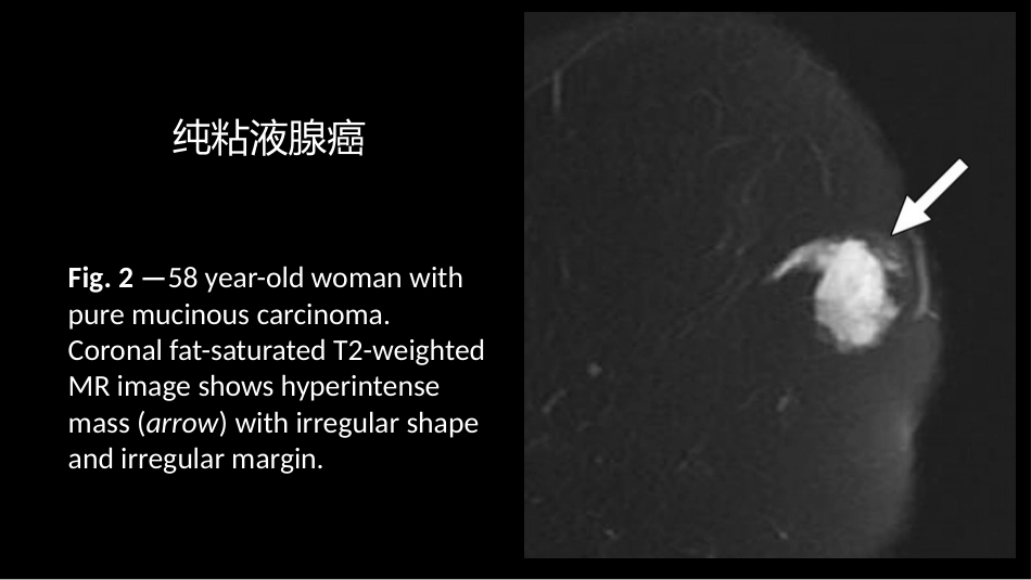 乳腺粘液腺癌MR与病理特点_第3页