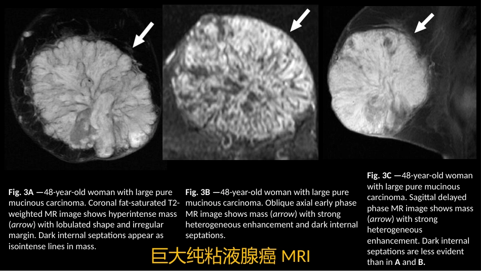 乳腺粘液腺癌MR与病理特点_第4页