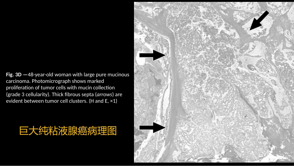 乳腺粘液腺癌MR与病理特点_第5页
