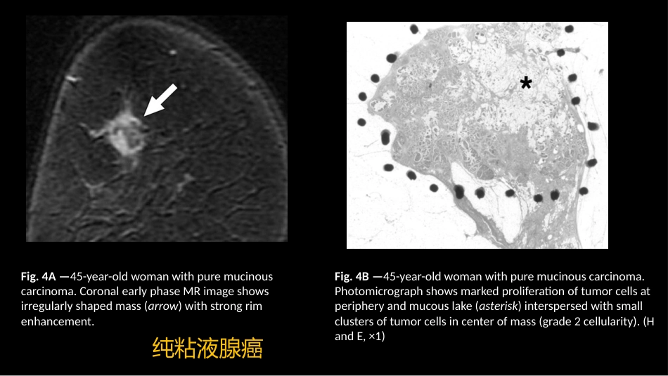 乳腺粘液腺癌MR与病理特点_第6页