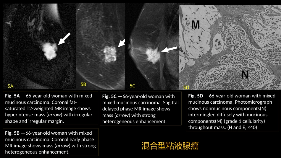 乳腺粘液腺癌MR与病理特点_第7页