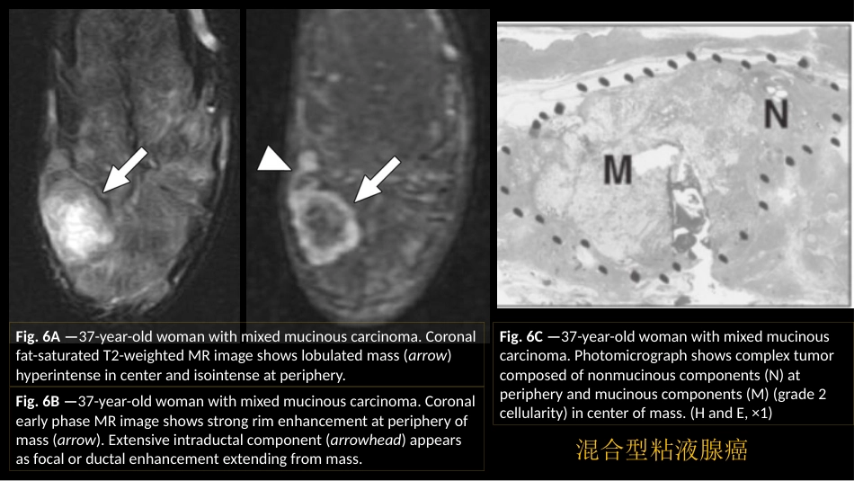 乳腺粘液腺癌MR与病理特点_第8页