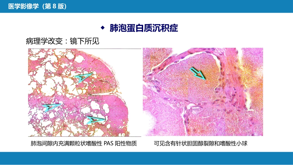 第四章 呼吸系统 第四节 疾病诊断-弥漫性肺疾病、肺肿瘤_第12页