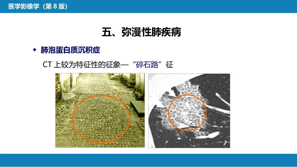 第四章 呼吸系统 第四节 疾病诊断-弥漫性肺疾病、肺肿瘤_第14页