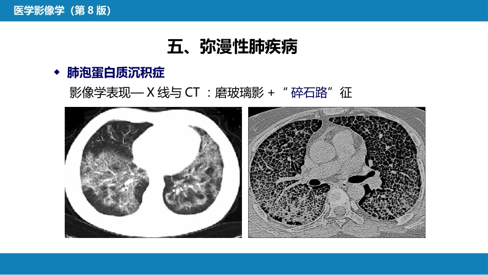 第四章 呼吸系统 第四节 疾病诊断-弥漫性肺疾病、肺肿瘤_第15页