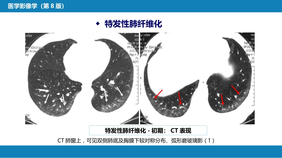 第四章 呼吸系统 第四节 疾病诊断-弥漫性肺疾病、肺肿瘤_第7页