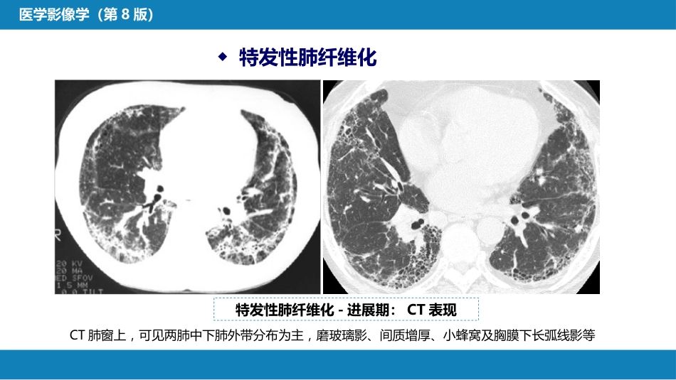 第四章 呼吸系统 第四节 疾病诊断-弥漫性肺疾病、肺肿瘤_第8页