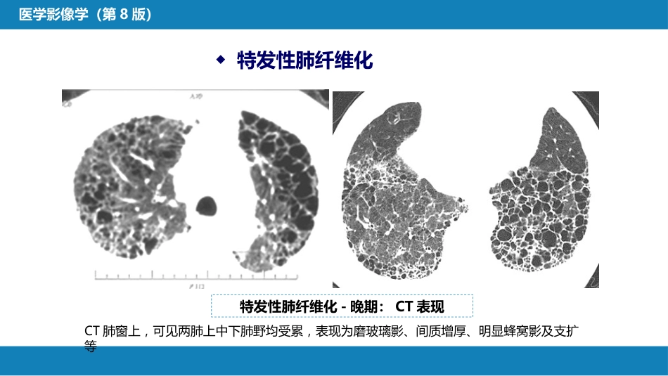 第四章 呼吸系统 第四节 疾病诊断-弥漫性肺疾病、肺肿瘤_第9页