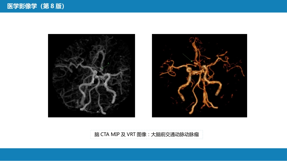 第二章 中枢神经系统 第三节 基本病变表现_第13页