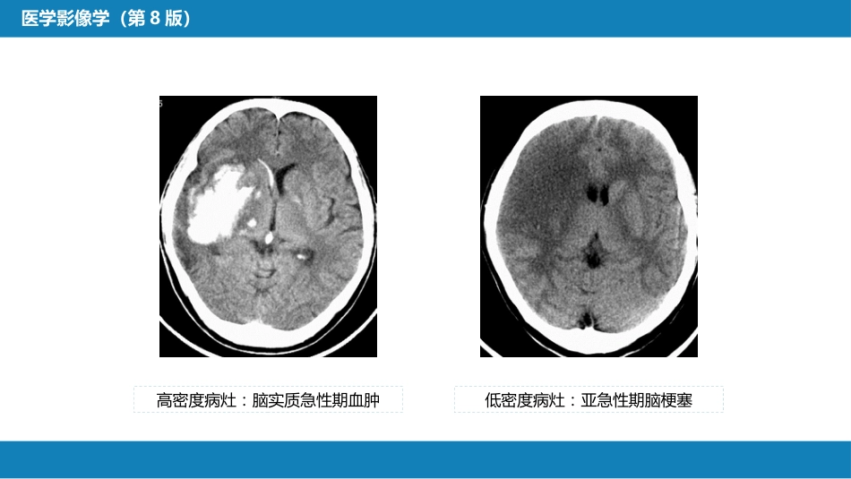 第二章 中枢神经系统 第三节 基本病变表现_第6页