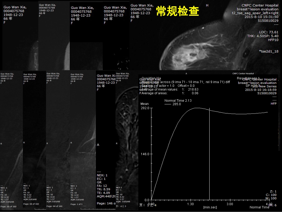 乳腺影像学检查与诊断_第13页