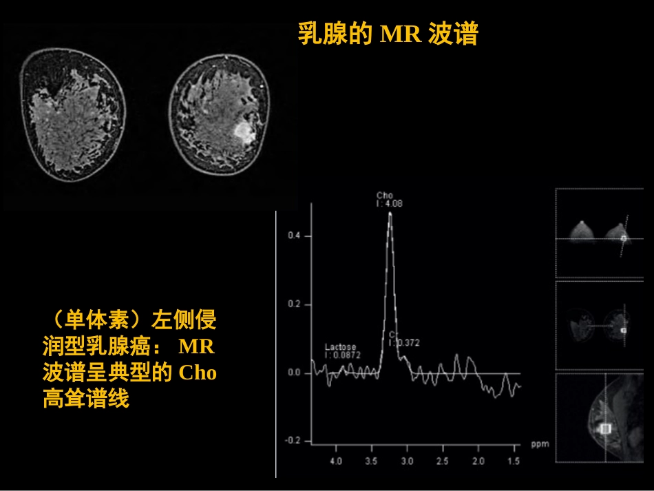 乳腺影像学检查与诊断_第14页