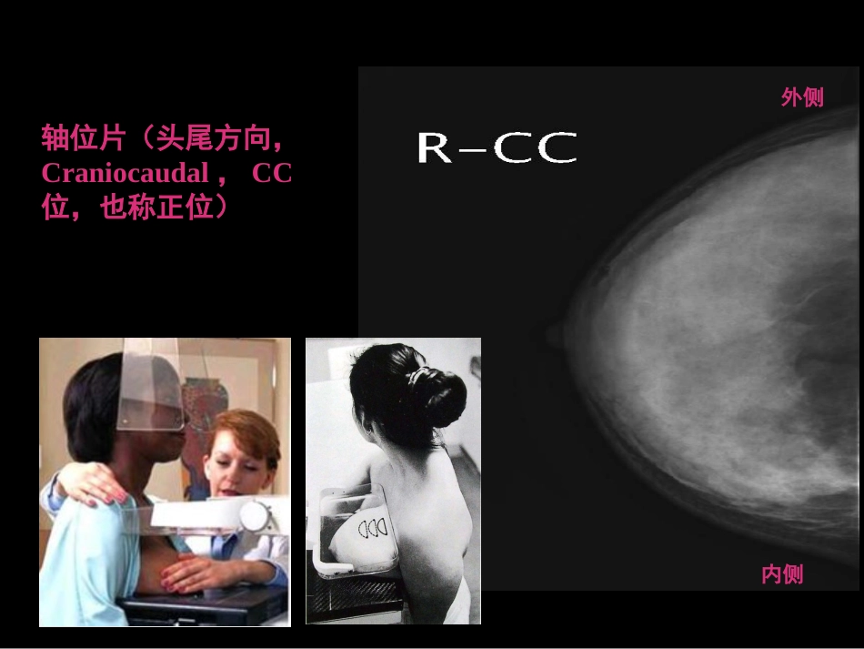 乳腺影像学检查与诊断_第5页
