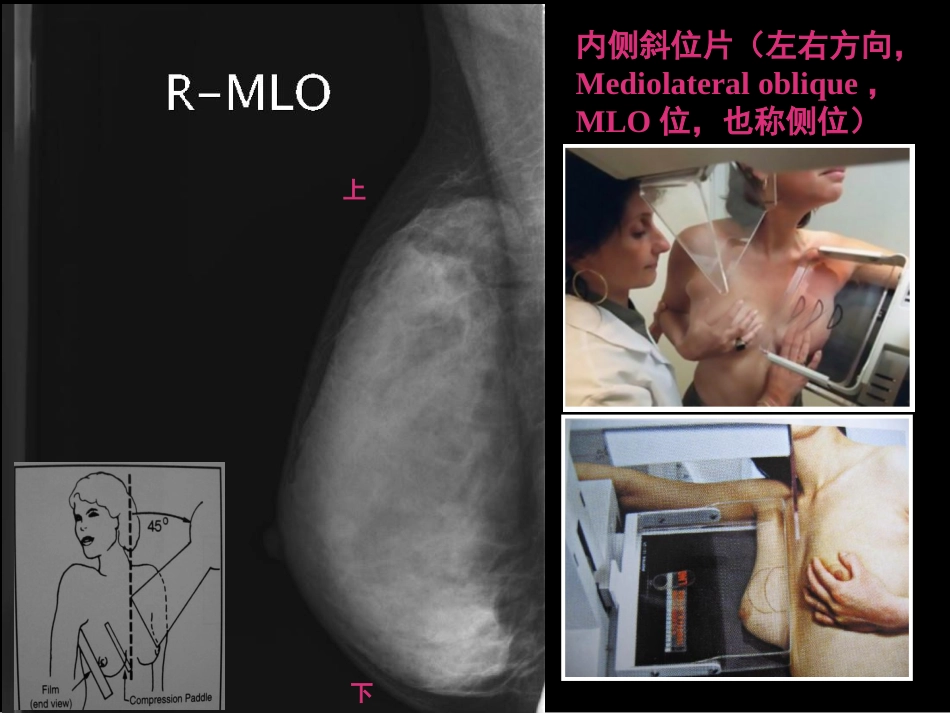 乳腺影像学检查与诊断_第6页