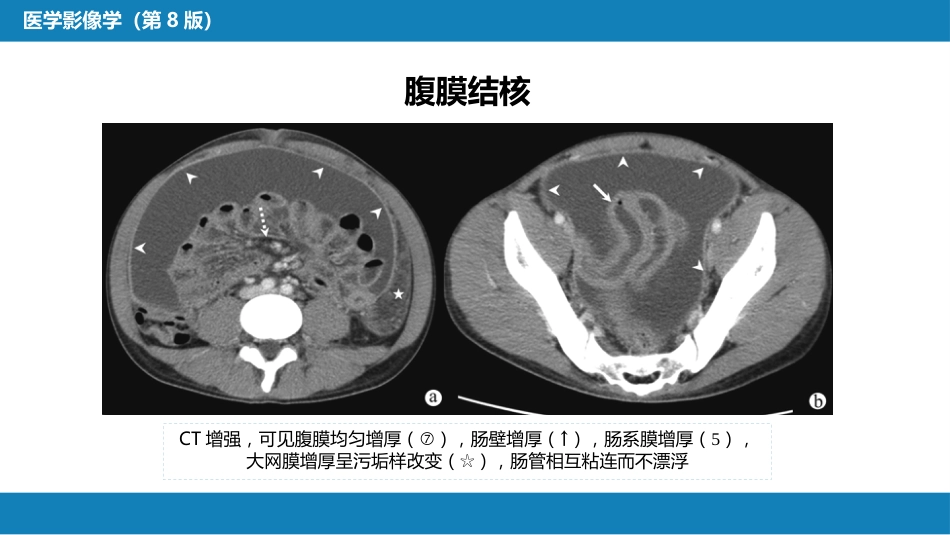 第七章 消化系统与腹膜腔 第三节 腹膜腔和肠系膜_第14页