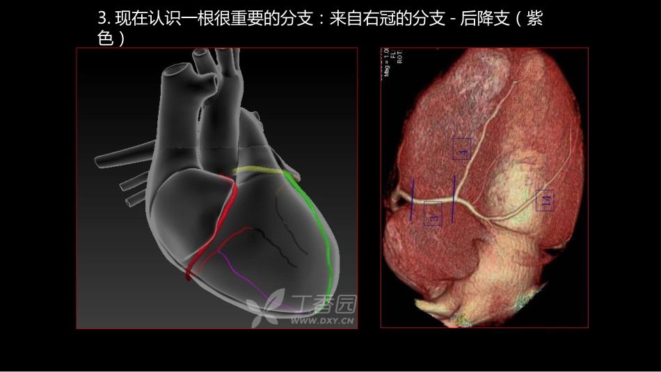 多层螺旋CT冠状动脉疾病诊断再学习之一_第8页