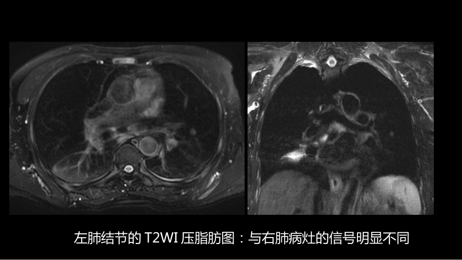 这例肺部病灶的比较影像学：价值评判_第10页