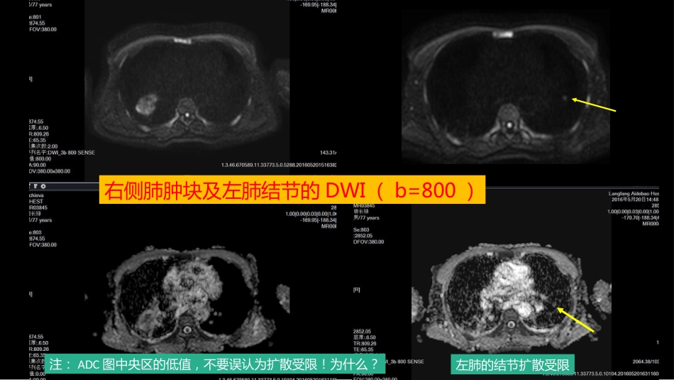 这例肺部病灶的比较影像学：价值评判_第11页