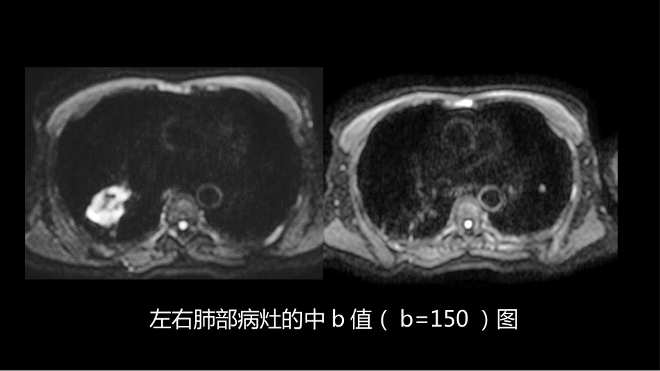 这例肺部病灶的比较影像学：价值评判_第12页