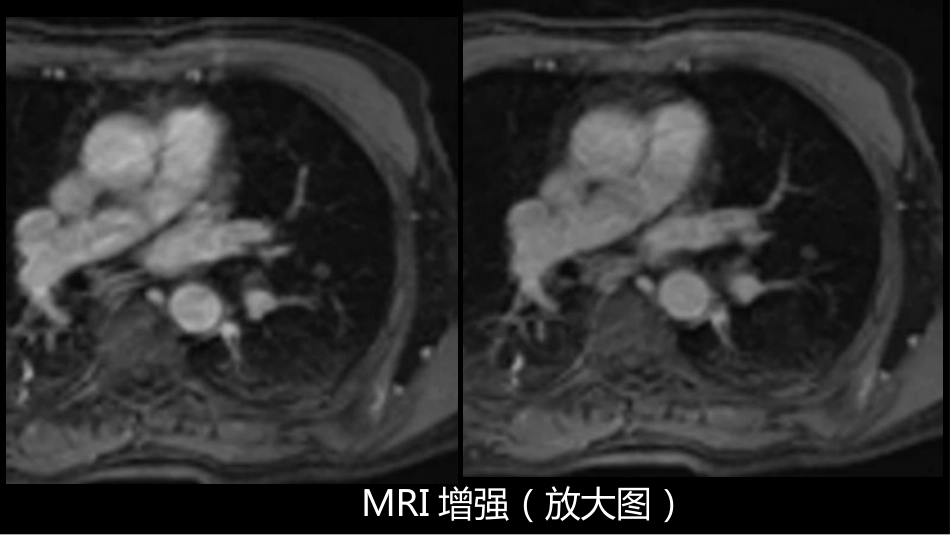 这例肺部病灶的比较影像学：价值评判_第15页
