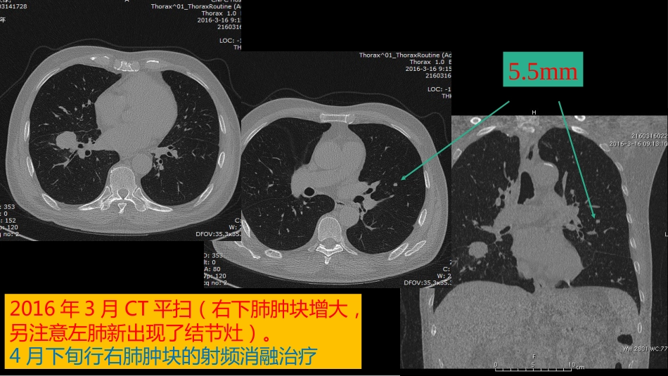 这例肺部病灶的比较影像学：价值评判_第4页