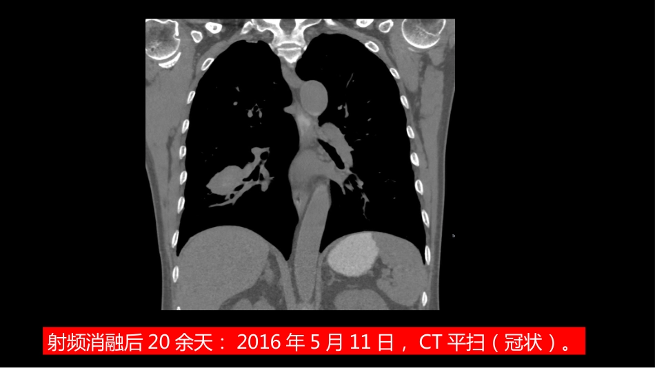 这例肺部病灶的比较影像学：价值评判_第5页