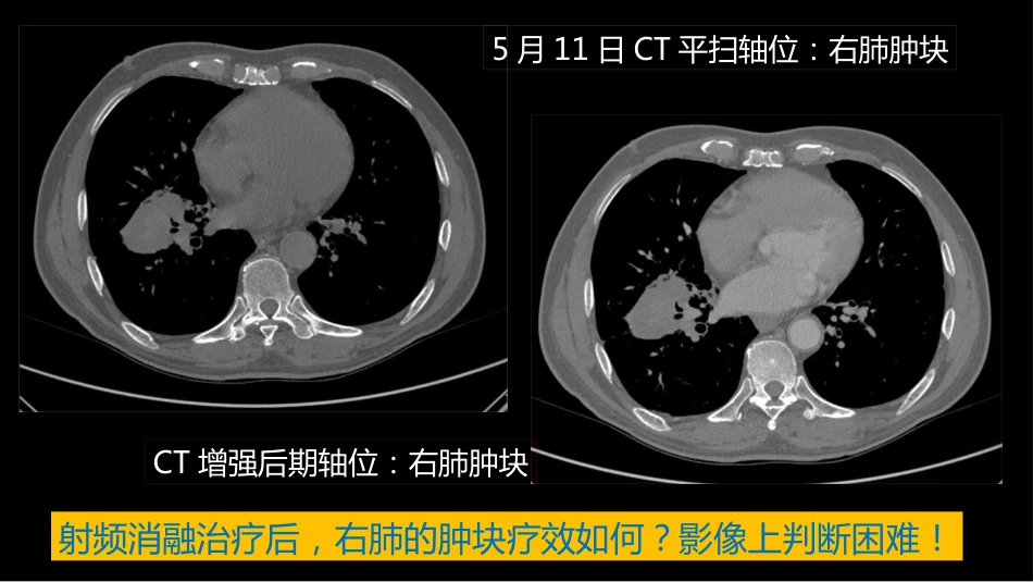这例肺部病灶的比较影像学：价值评判_第6页