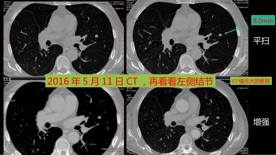 这例肺部病灶的比较影像学：价值评判_第7页