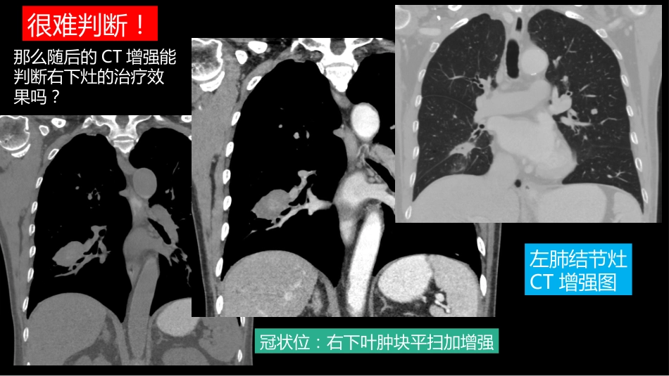 这例肺部病灶的比较影像学：价值评判_第8页
