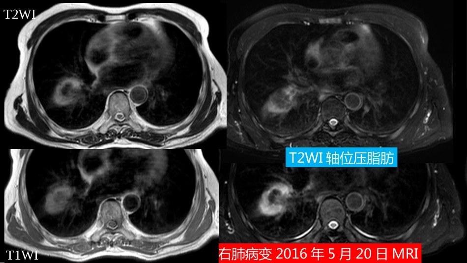 这例肺部病灶的比较影像学：价值评判_第9页