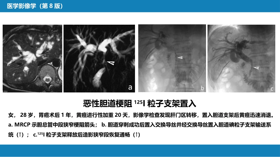 第十四章 非血管疾病介入治疗_第10页