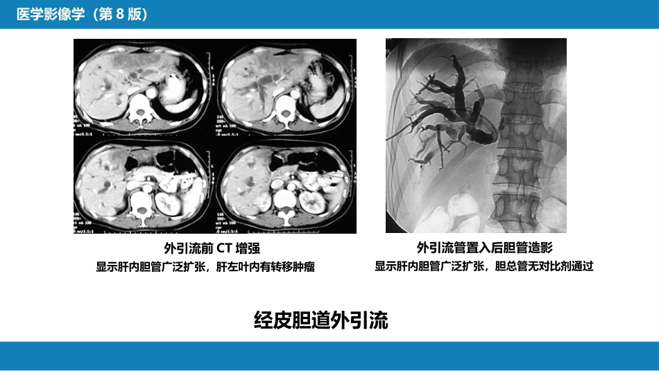 第十四章 非血管疾病介入治疗_第8页